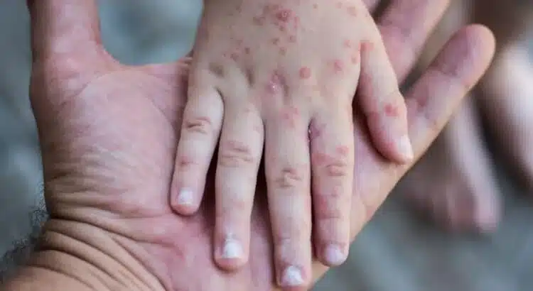 Piden declarar alerta epidemiológica en Sinaloa, ante brote de sarampión