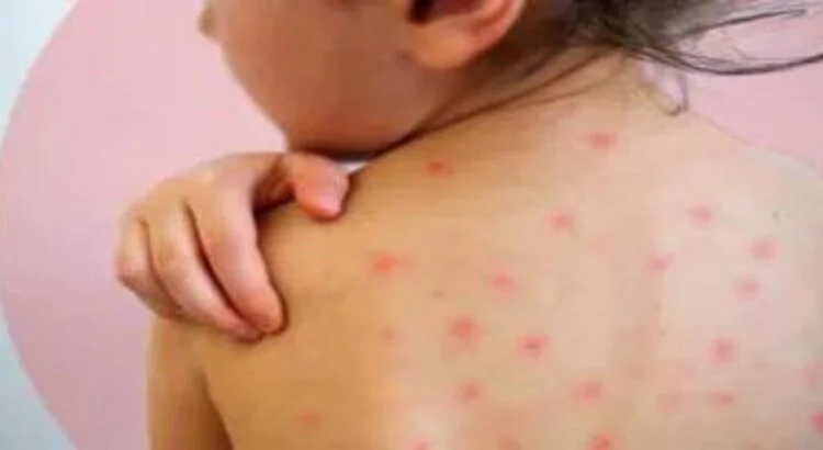 Rebasa Michoacán los 200 casos de sarampión