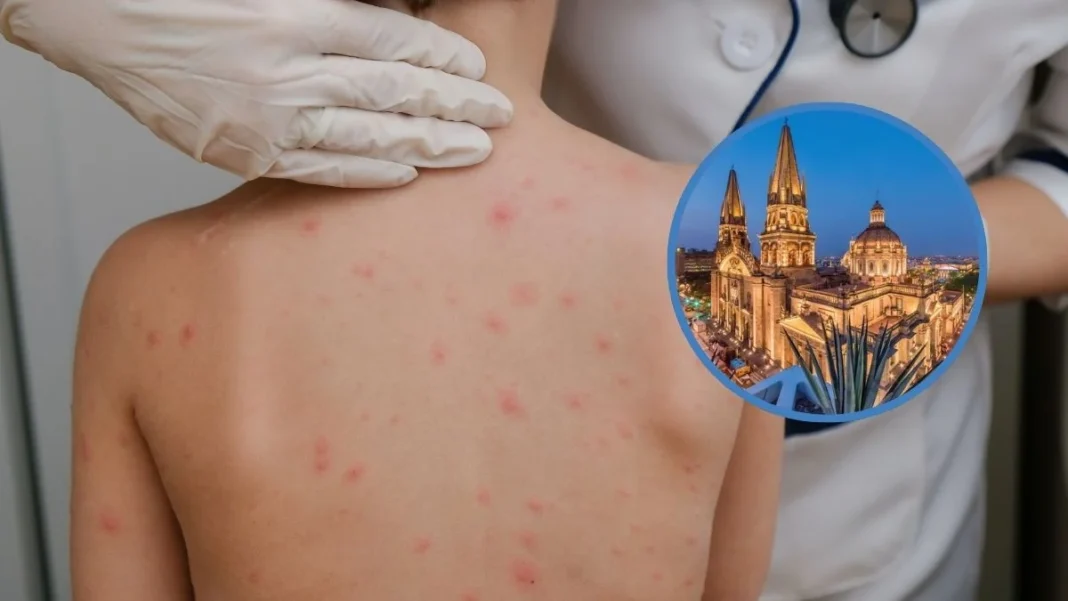 Confirman 11 casos con complicaciones por sarampión en Jalisco