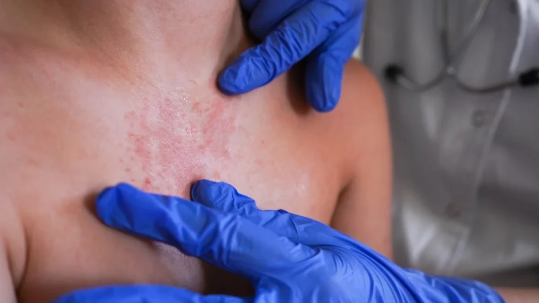 Existe un posible brote de sarampión en Guadalupe Victoria